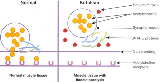 Botulinum Toxin Resistance: Causes and Solutions